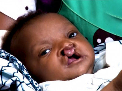 Baby born different (with a cleft palate)