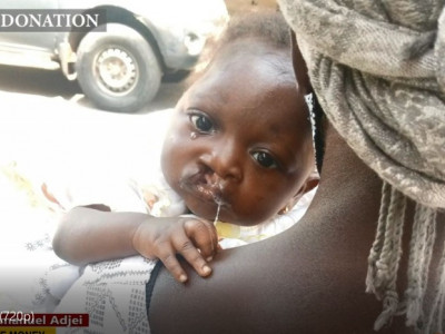 Adwoa is kid who is suffering from Cleft Lip