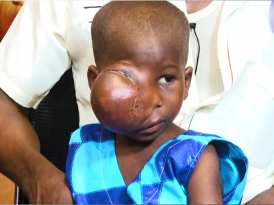 Rose Nyame, a patient with a tumor
